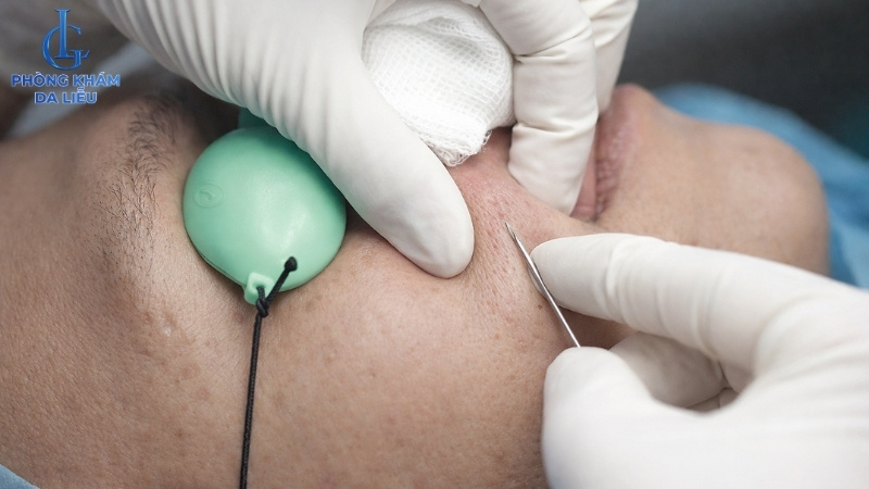 quy trình cắt đáy sẹo rỗ