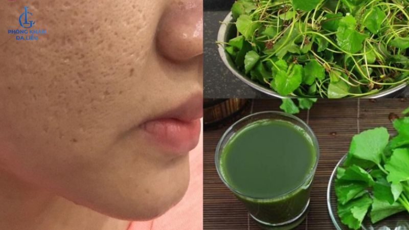 rau má trị sẹo rỗ mới hình thành