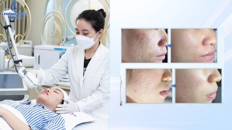 Điều trị sẹo rỗ