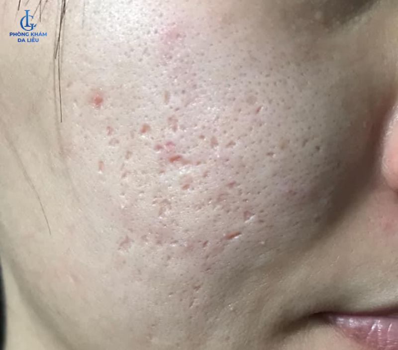sẹo rỗ nhẹ
