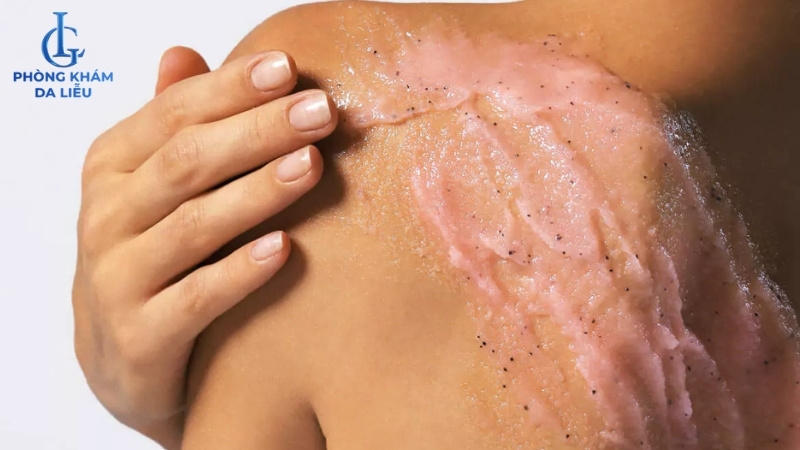 sử dụng sản phẩm trị mụn lưng phù hợp