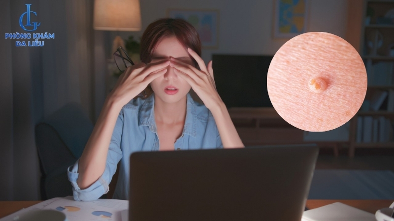 thức khuya có thể tăng nguy cơ mụn thịt ở lưng