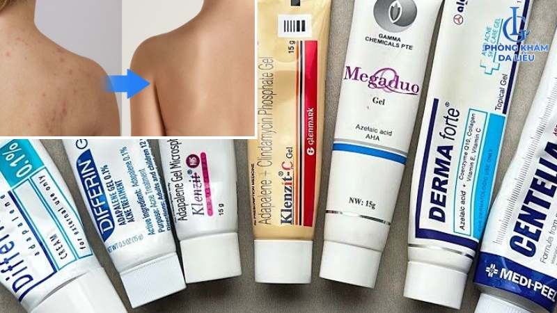 thuốc bội mụn bọc ở lưng