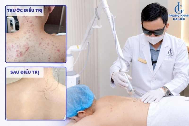 trị mụn bọc ở lưng bằng công nghệ laser