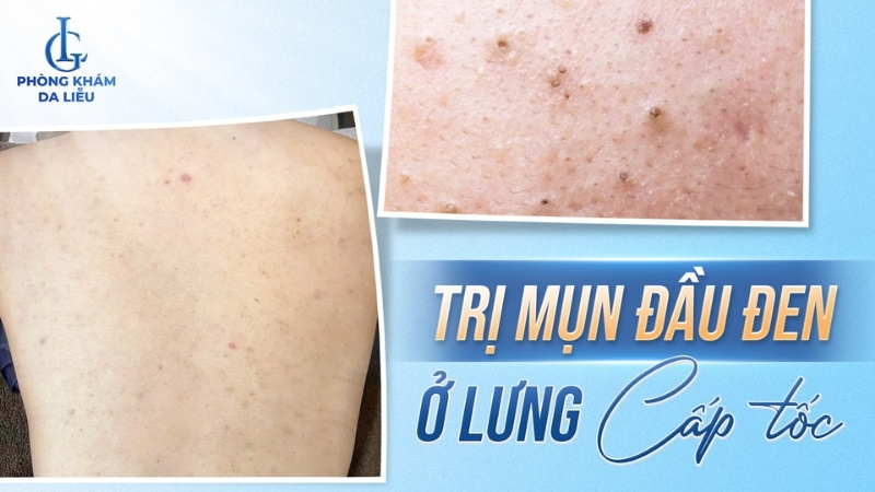 trị mụn đầu đen ở lưng