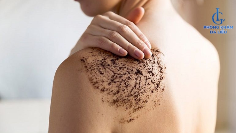 tẩy tế bào chết trị mụn lưng