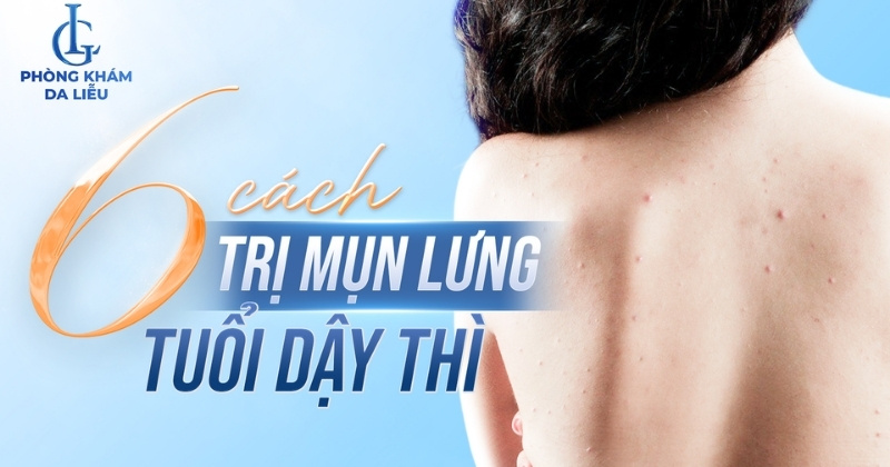 trị mụn lưng tuổi dậy thì
