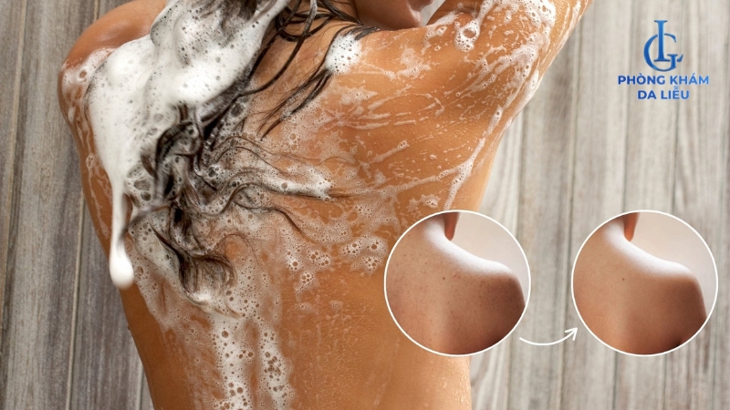 sữa tắm trị mụn lưng