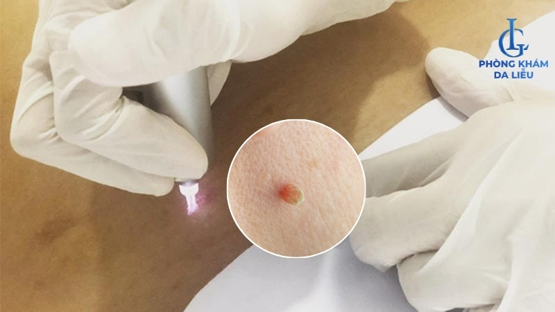 trị mụn thịt ở lưng