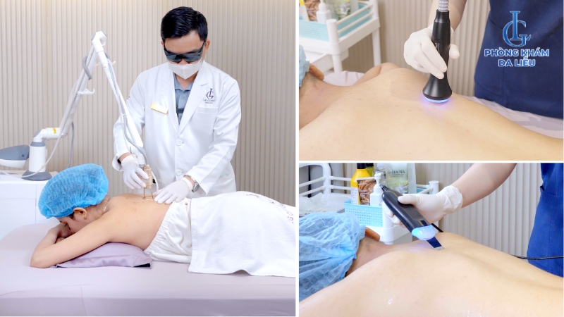 điều trị mụn ở lưng và vai