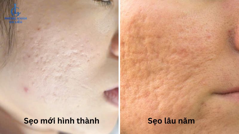sẹo rỗ nhẹ và sẹo rỗ lâu năm