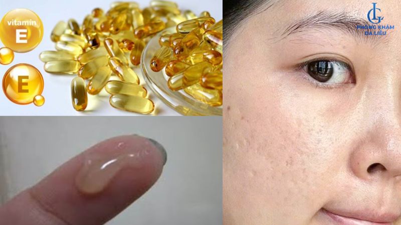 Vitamin E trị sẹo rỗ