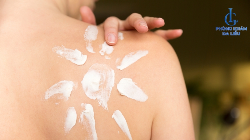 sử dụng chống nắng điều trị thâm mụn lưng