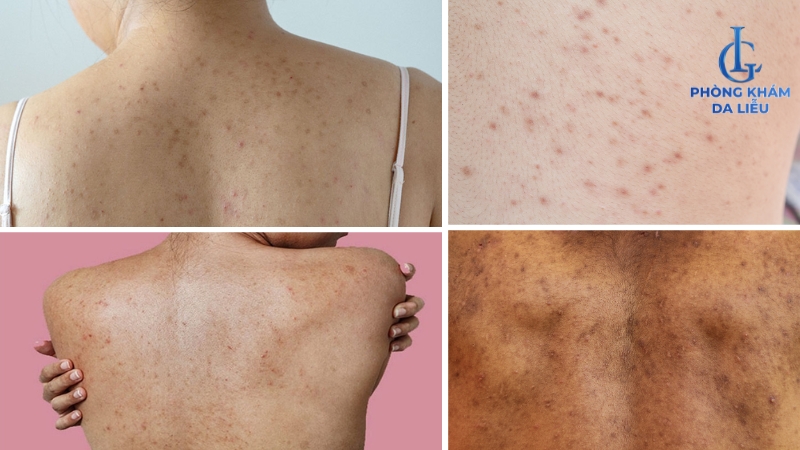 trị thâm mụn lưng