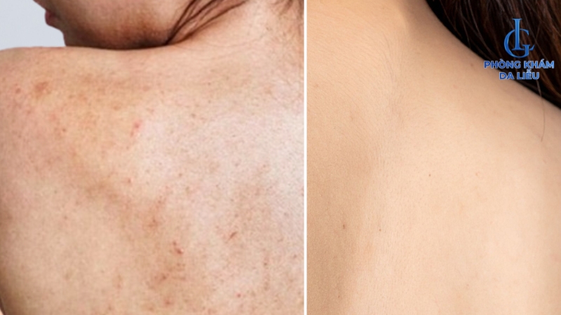 trị thâm mụn lưng với vtm C