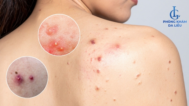 không dùng retinol trị thâm mụn