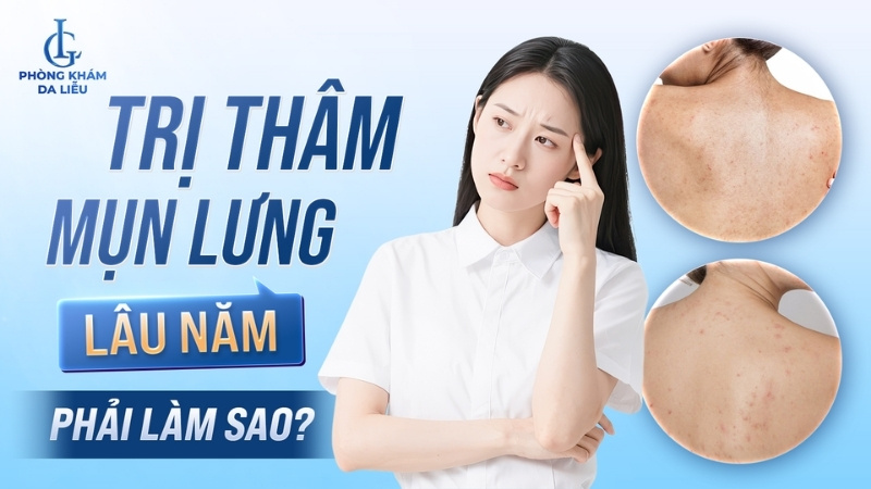 trị thâm mụn lưng