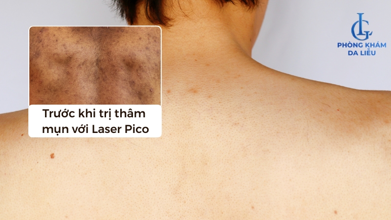 trị thâm mụn lưng lâu năm