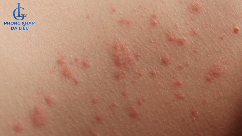 viêm da tiếp xúc gây nổi mẩn đỏ ở lưng