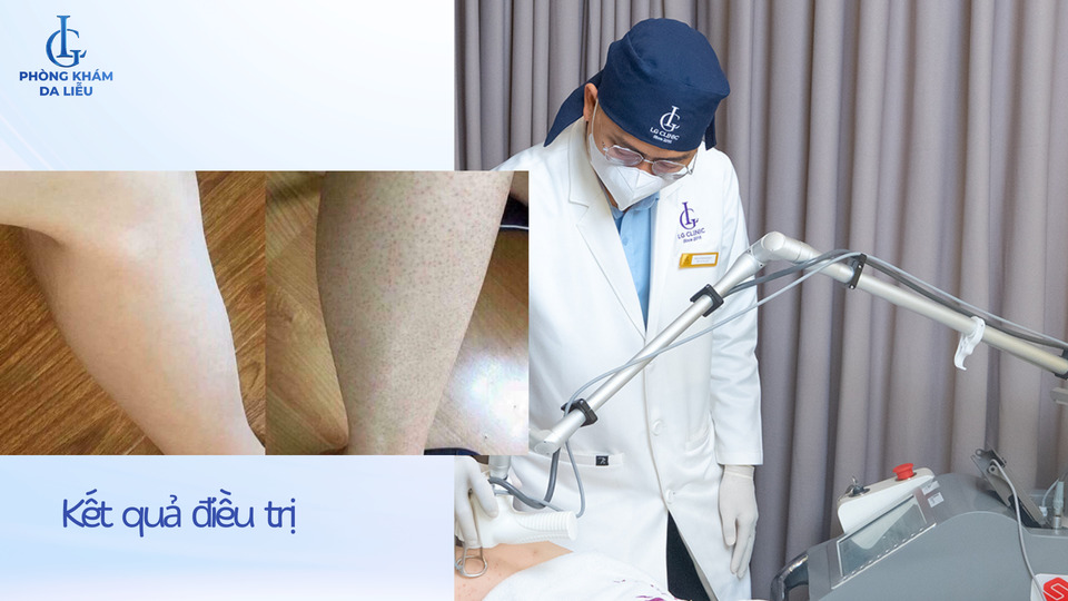 Trị viêm lỗ chân lông bắp chân tại Phòng khám Da liễu LG