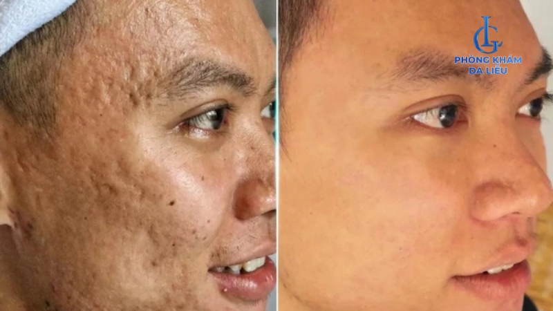 Sẹo rỗ cải thiện