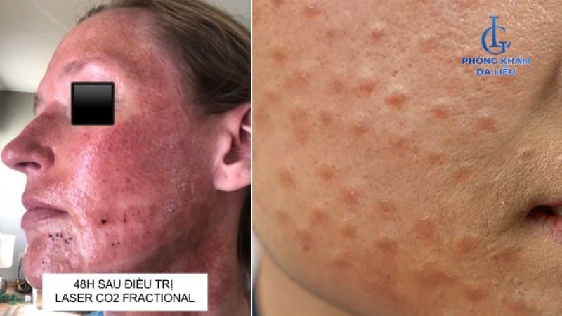 sau khi điều trị sẹo rỗ