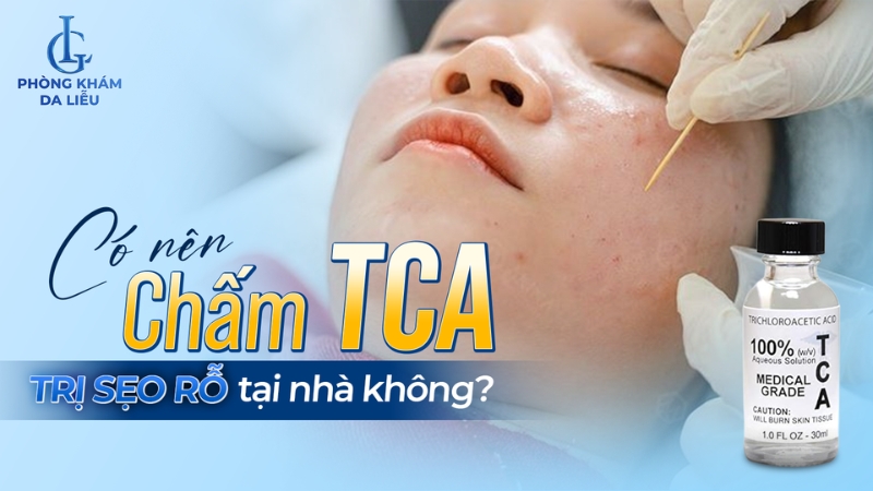 Chấm tca trị sẹo rỗ