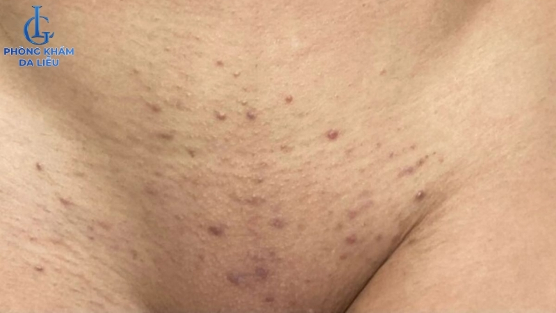 Hình ảnh viêm lỗ chân lông vùng kín