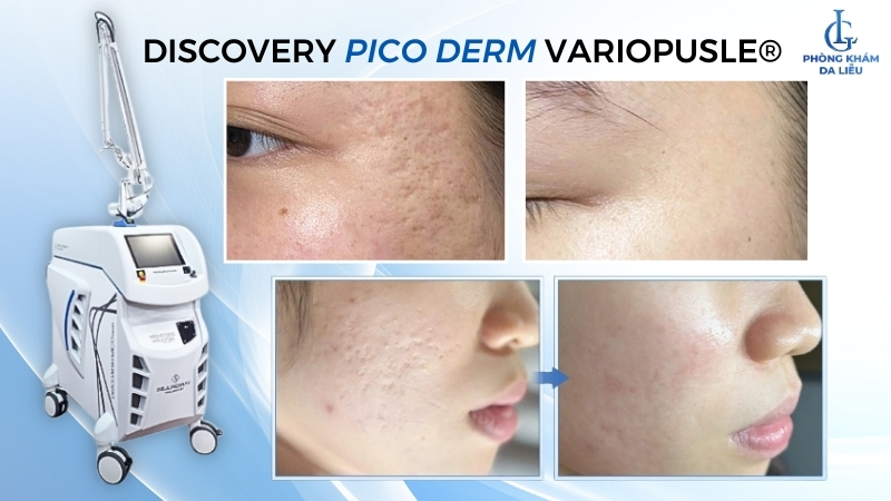 Laser trị sẹo lõm