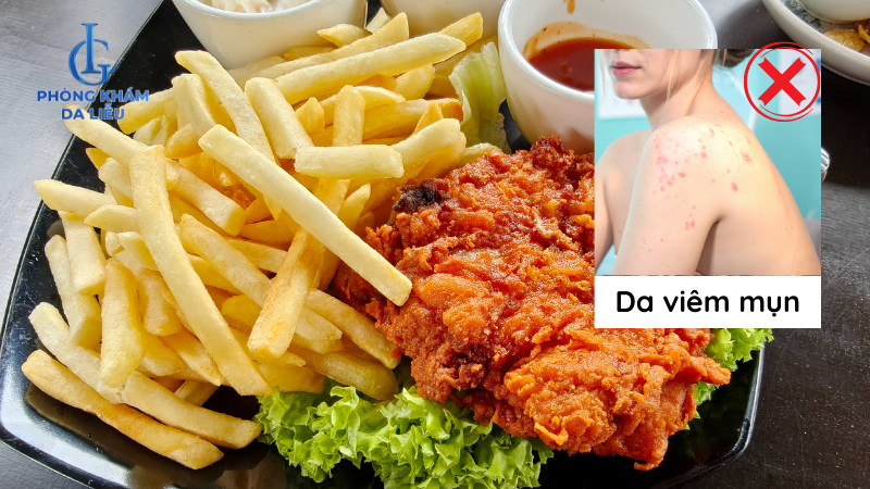 bị mụn lưng kiếng món ăn dầu mỡ