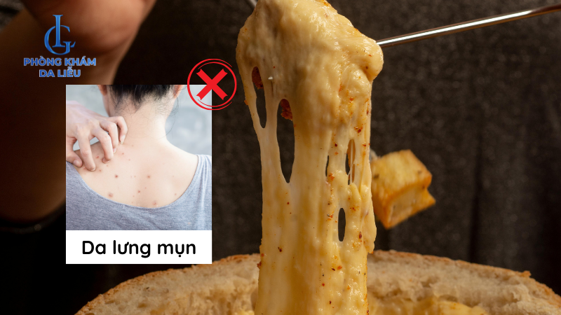 người bị mụn lưng nên giảm sữa