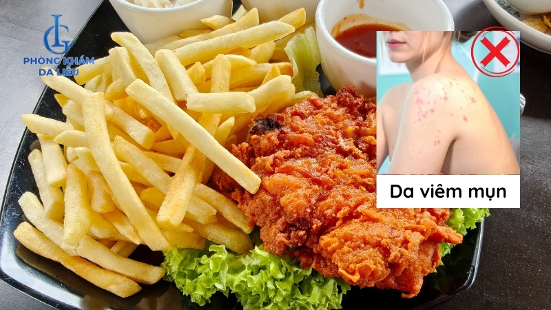 bị mụn lưng kiêng ăn gì bây giờ
