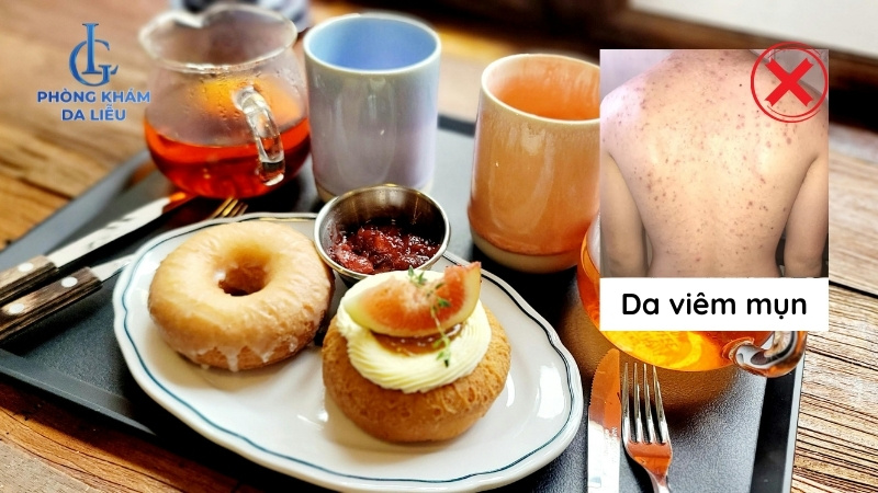 bị mụn lưng kiêng ăn gì mau hết