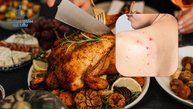 bị mụn lưng kiêng ăn những gì