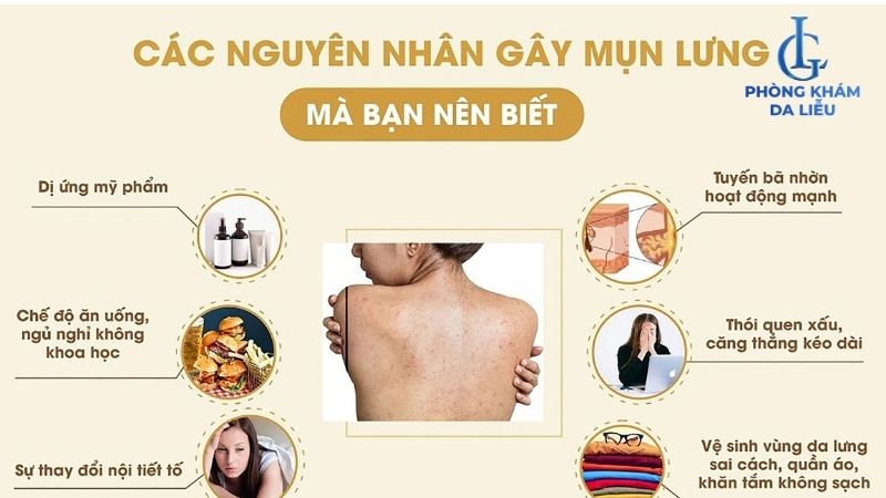 nguyên nhân bị mụn ở cổ và lưng