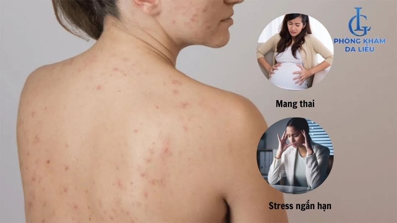 bị mụn ở cổ và lưng