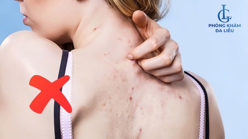 không tự nặn mụn