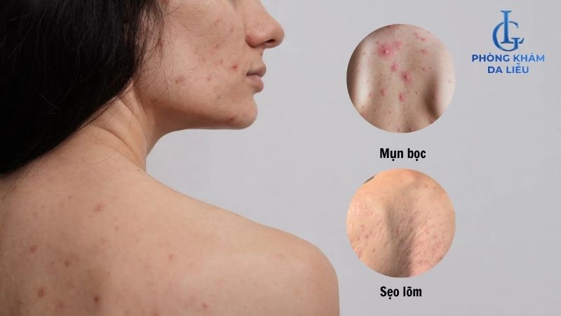 khám mụn ở cổ và lưng