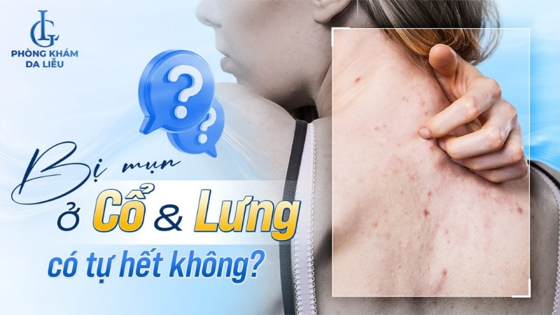 bị mụn ở cổ và lưng