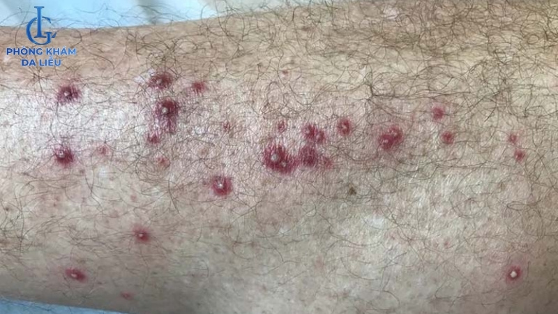 biến chứng của viêm nang lông