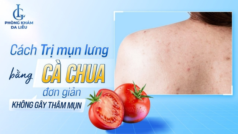 cách trị mụn lưng bằng cà chua