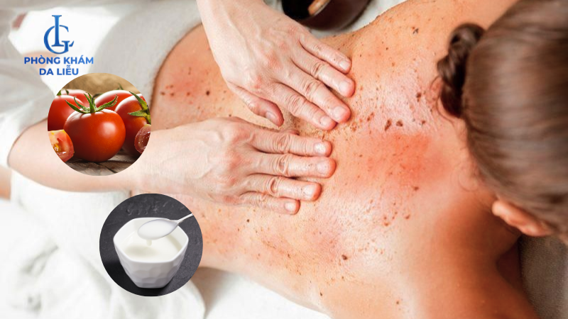 cà chua và sữa chua trị mụn lưng