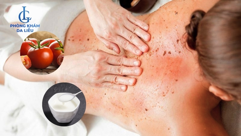 cách trị mụn lưng bằng cà chua ở nhà