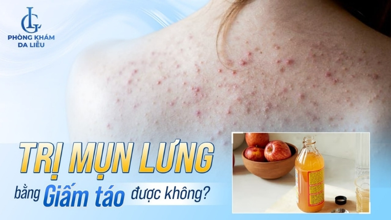 cách trị mụn lưng bằng giấm táo