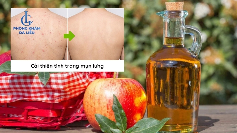 cách trị mụn lưng bằng giấm táo tại nhà