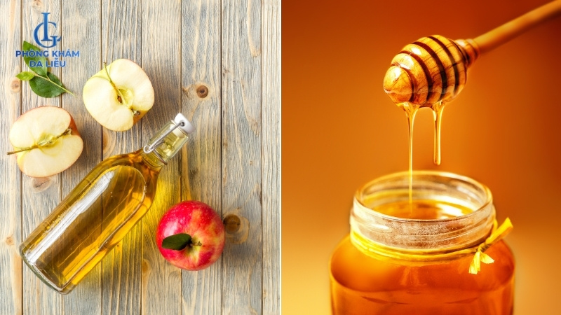 cách trị mụn lưng bằng giấm táo
