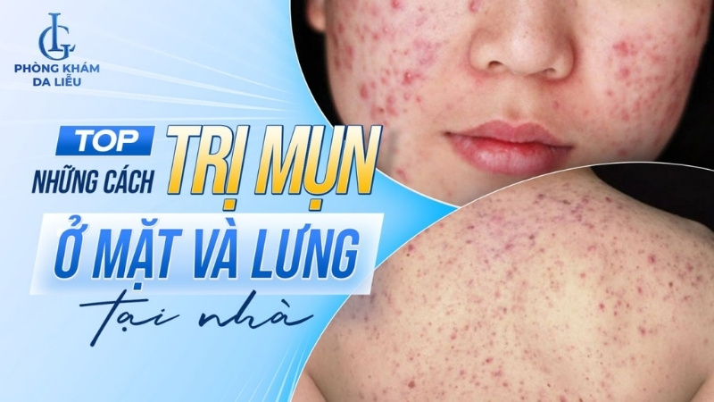cách trị mụn ở mặt và lưng