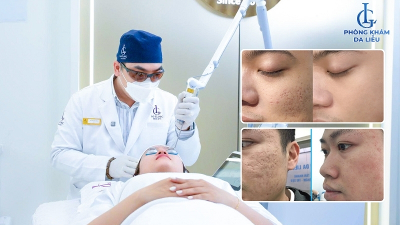 cách trị sẹo lõm