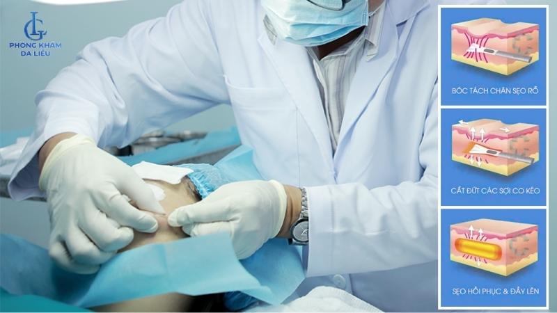 điều trị sẹo lõm