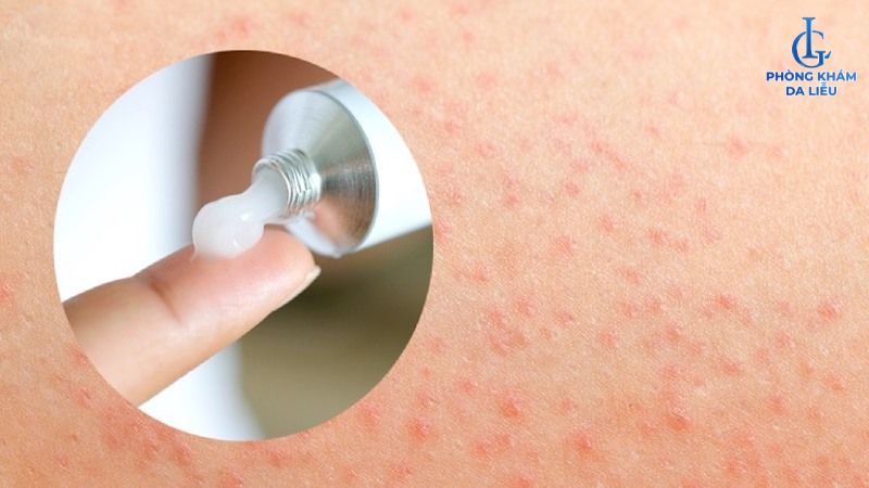 cách chữa viêm nang lông